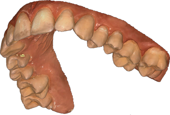 About 1 Intraoral scan file ply 3D